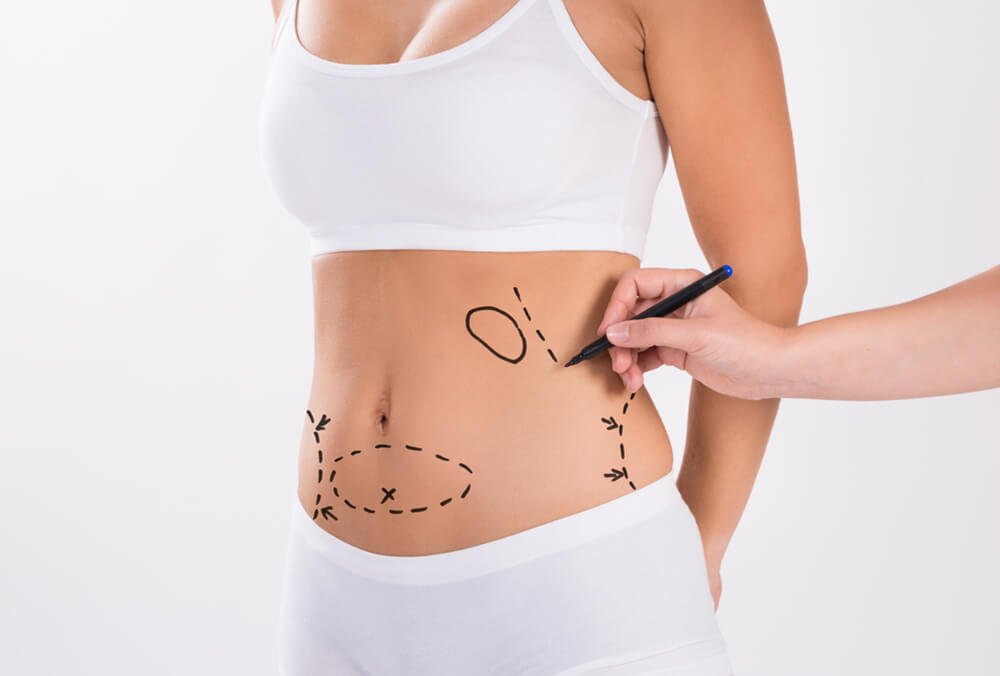 Liposuction in Dubai