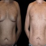 Before and After Male Breast Reduction Results