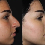 Dubai Rhinoplasty: Thick Skin Success