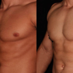 gynecomastia surgery dubai