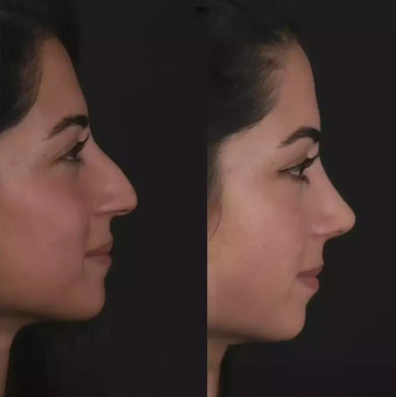 Combining Septoplasty and Rhinoplasty in Dubai?